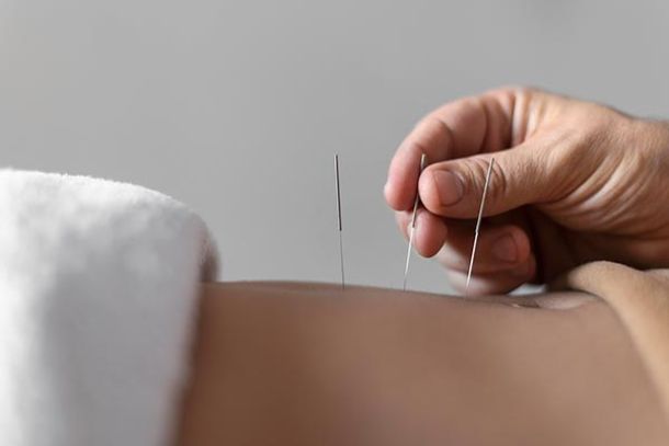 acupuncture being performed